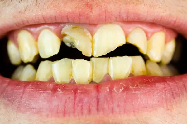 Relación entre drogas y pérdida dental ¿Por qué se caen?